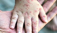 به صدا درآمدن زنگ خطر بیماری سرخک در بابل