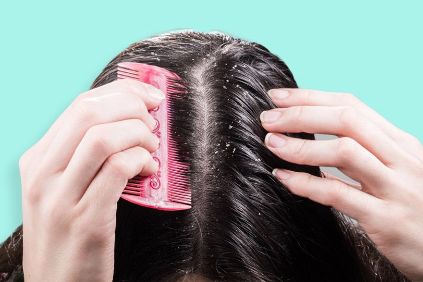 پوسته‌های سر به دلیل شوره است یا خشکی پوست؟