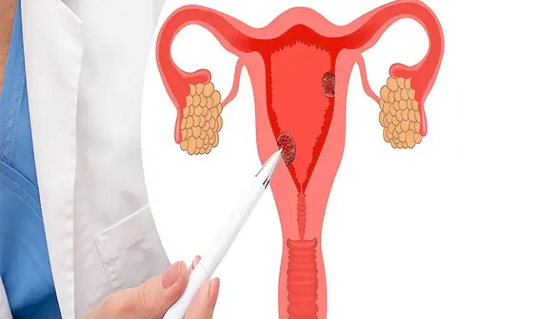 همه چیز درباره پولیپ‌های رحم