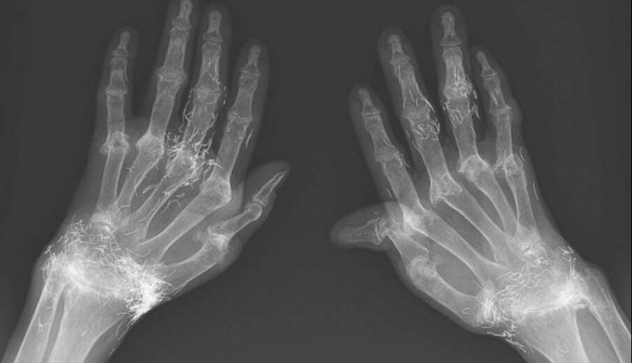 کشف صدها رشته طلای خالص در زانوی زن مبتلا به آرتروز