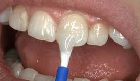 فلورایدتراپیِ دندانِ کودکان را از این سن شروع کنید